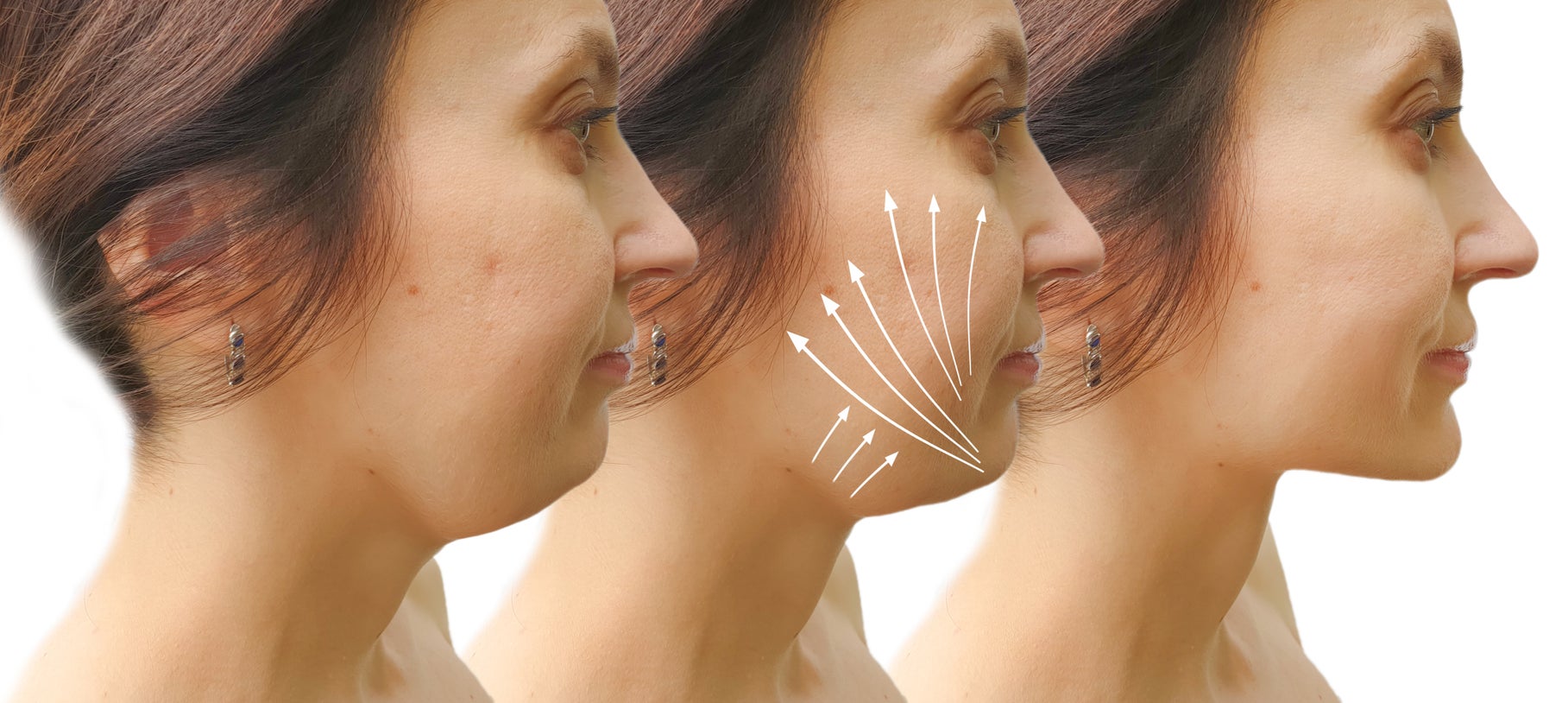 Ultrasonic Cavitation Body Shaping